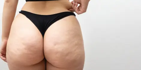 Celulitis relacionado 3